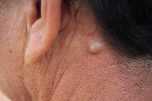 Lump Behind Ear: Causes, Diagnosis and Treatment